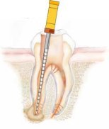 abcessed tooth