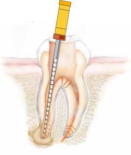 Pain after Root Canal